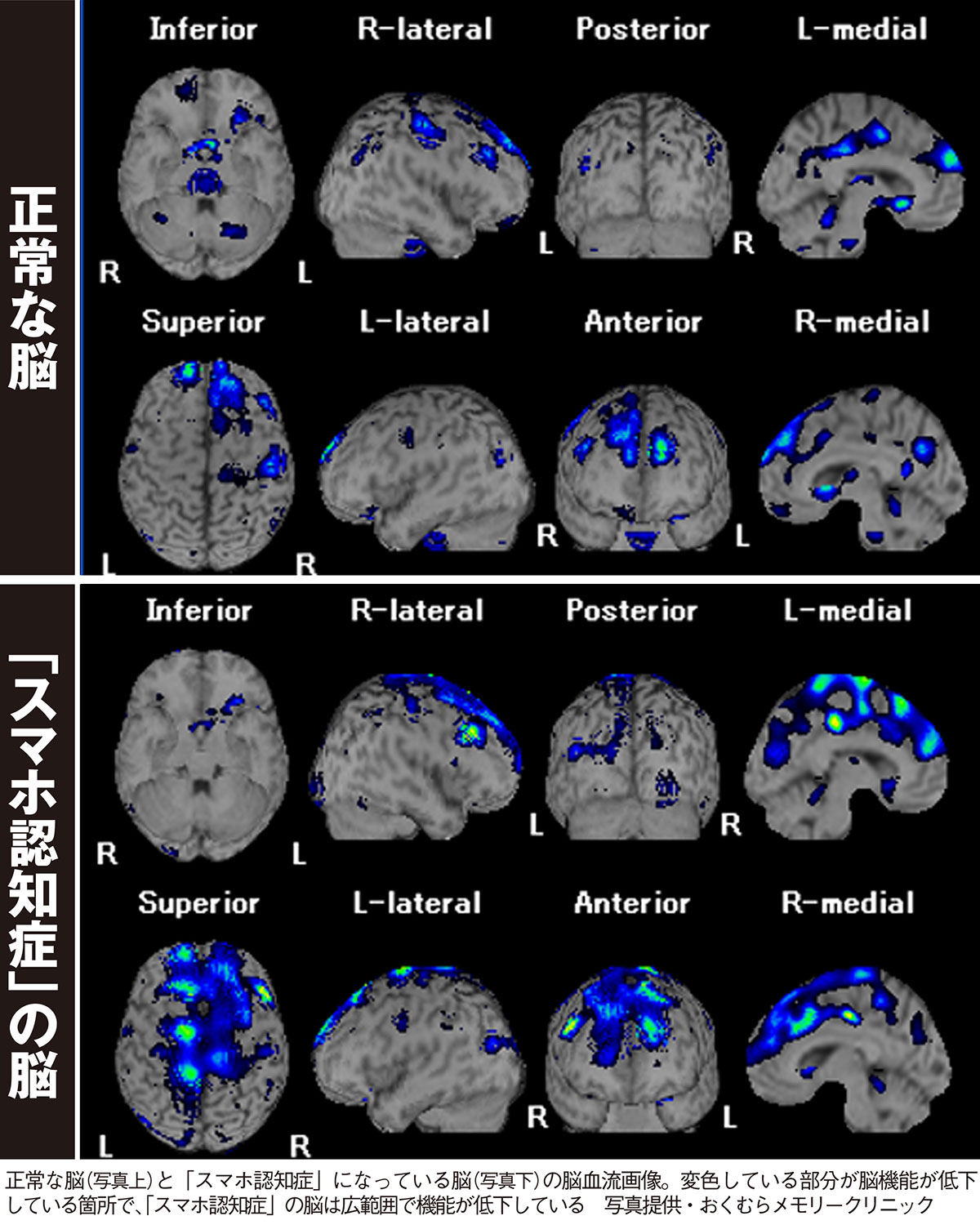 イライラ・睡眠トラブル・もの忘れ…全部「スマホ認知症」が原因だった!　将来のリスクを防ぐには“ぼんやりタイム”を