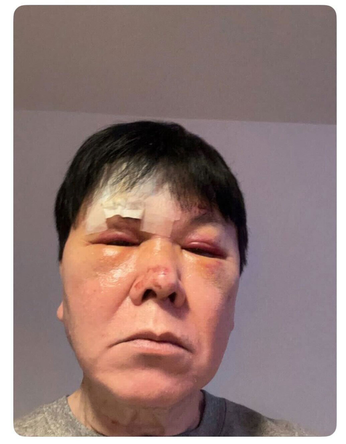 三ツ矢雄二のXより。《おでこがえぐれて、まぶたを4針縫って、鼻の骨が折れてました》と報告した。泥酔して転倒したという