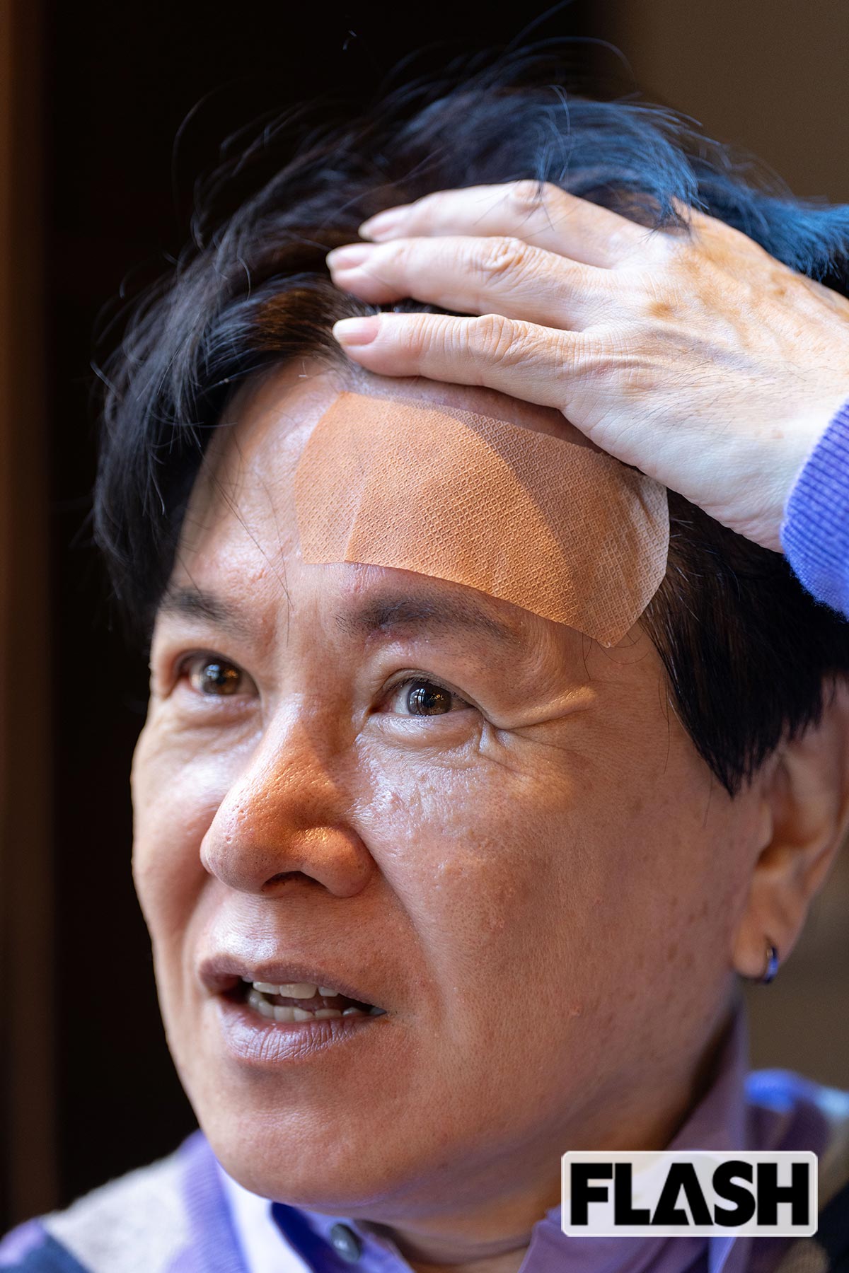 おでこの傷は、皮膚が再生したものの、へこんだままだという