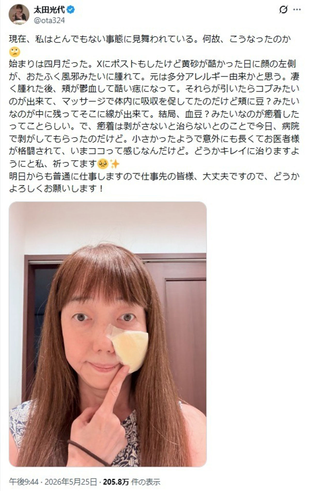 太田光代がアップした顔の半分を覆う巨大な痣。深刻な様子だ(写真・本人のXより)