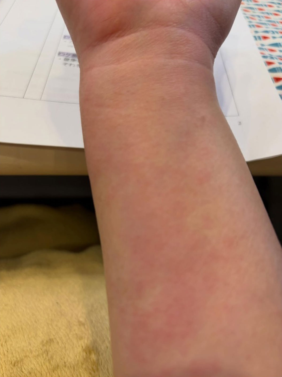 有働が投稿した腕の写真。真っ赤に腫れている（写真・本人のInstagramより）