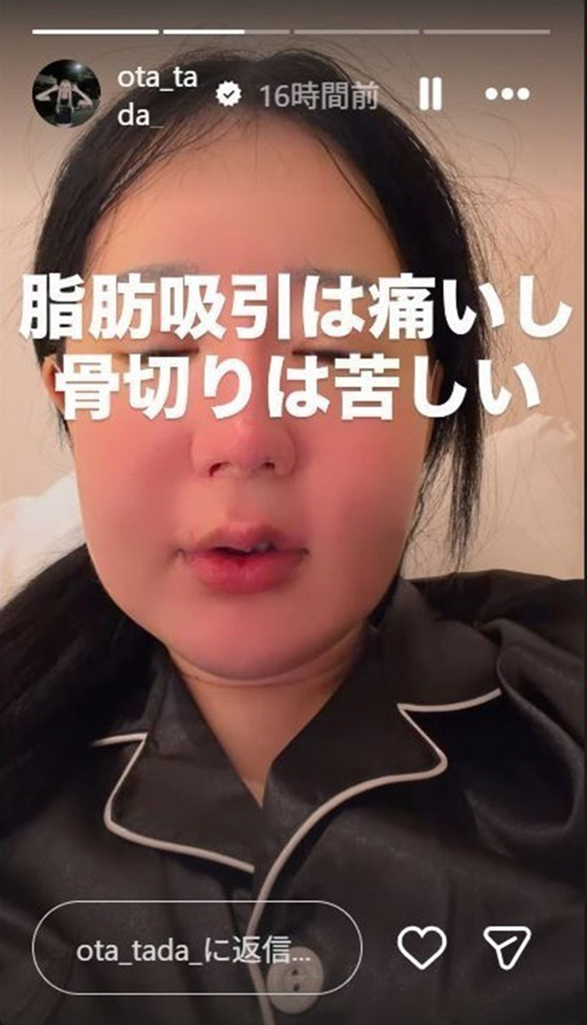 美容整形のために顔がパンパンに腫れあがった多田さん。心配の声がでている(写真・本人のInstagramより)