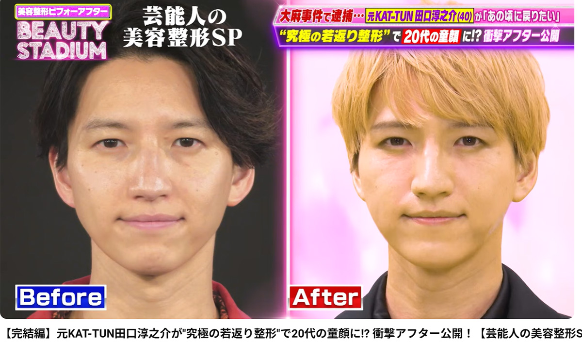 YouTube番組『ビューティースタジアム』で美容整形を受けた元KAT-TUNの田口淳之介（番組のYouTubeチャンネルに8月21日投稿）