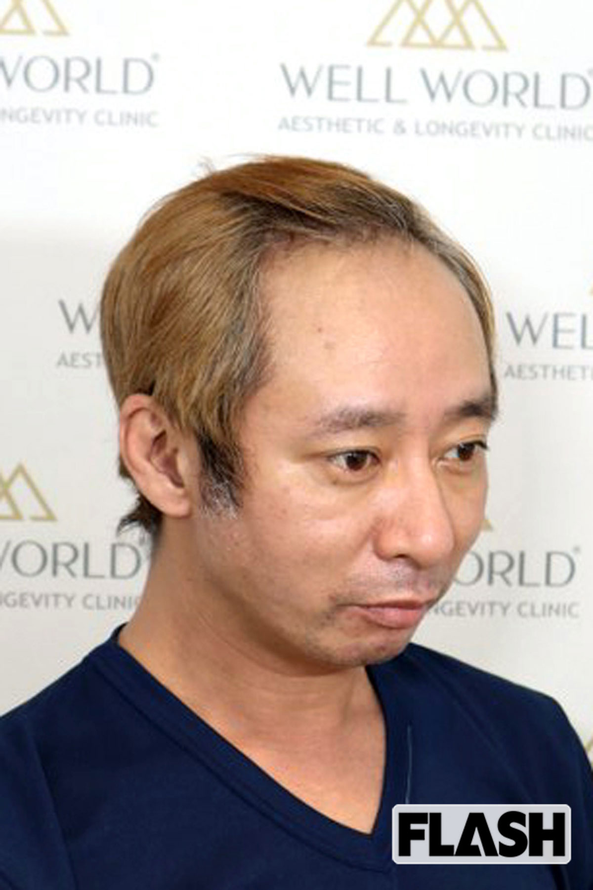 植毛前、自分に自信がなく、ネガティブ思考が抜けなかったころのいしだ壱成（提供・東京植毛クリニック）