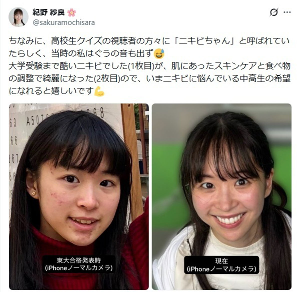 高校時代にテレビ出演し「ニキビちゃん」と呼ばれていた紀野紗良。ビフォーアフターを公開した(写真・本人のXより)